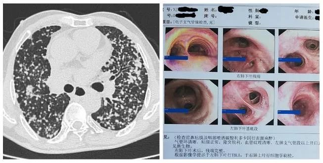 新技术周围型肺癌及纵隔肺门淋巴结肿大患者的福音
