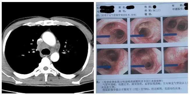 新技术周围型肺癌及纵隔肺门淋巴结肿大患者的福音