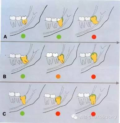 口腔麻醉拔牙术阻生牙拔除