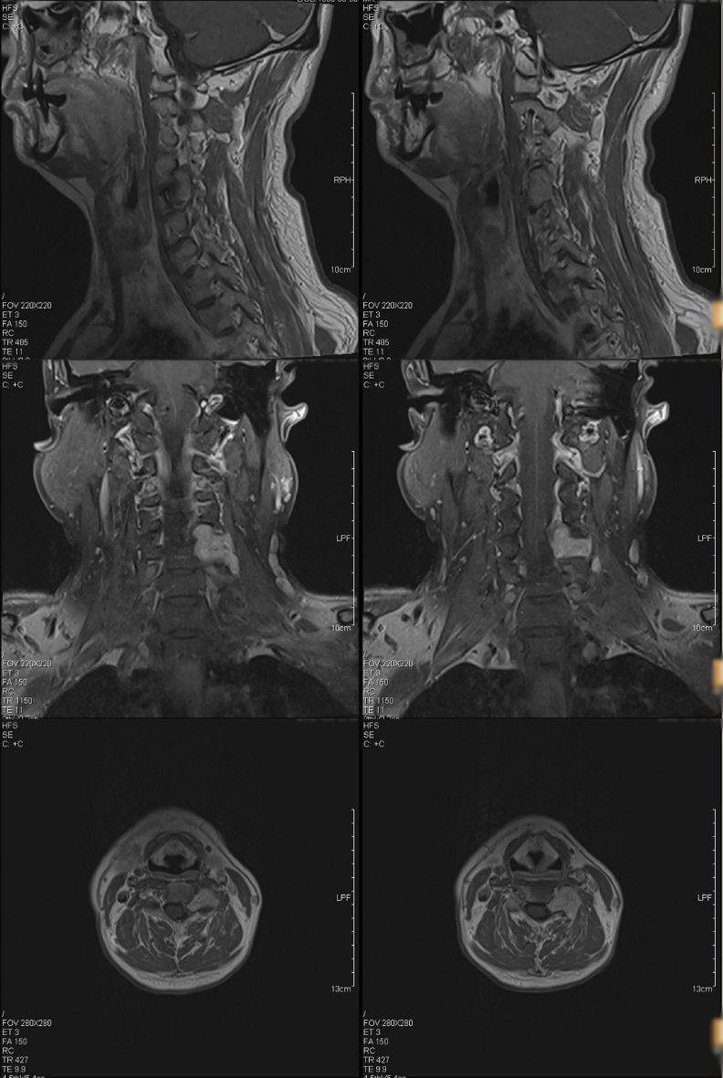 術前頸椎增強mri,提示頸4/5左側椎間孔及椎管內外啞鈴型腫瘤,考慮