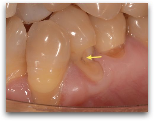 牙齿楔状缺损初期图片图片