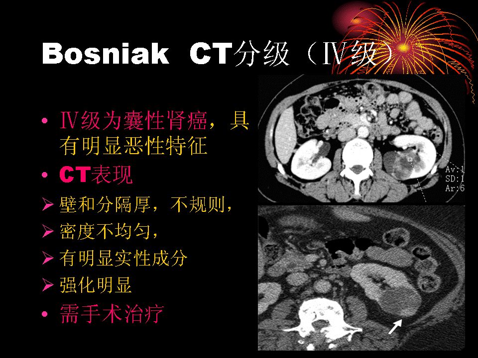 囊性腎癌的ct診斷