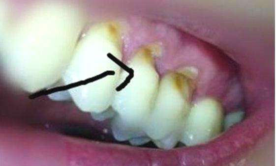 楔状缺损长啥样?_牙齿