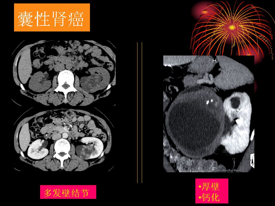 囊性腎癌的ct診斷