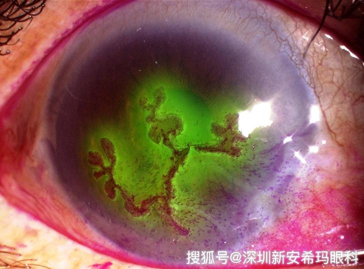 清楚显示单纯疱疹性角膜炎树枝状病变单纯疱疹病毒角膜炎的症状主要为