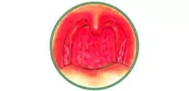 慢性咽炎,中医习称"阴虚喉痹"或"虚火喉痹",是现在很常见