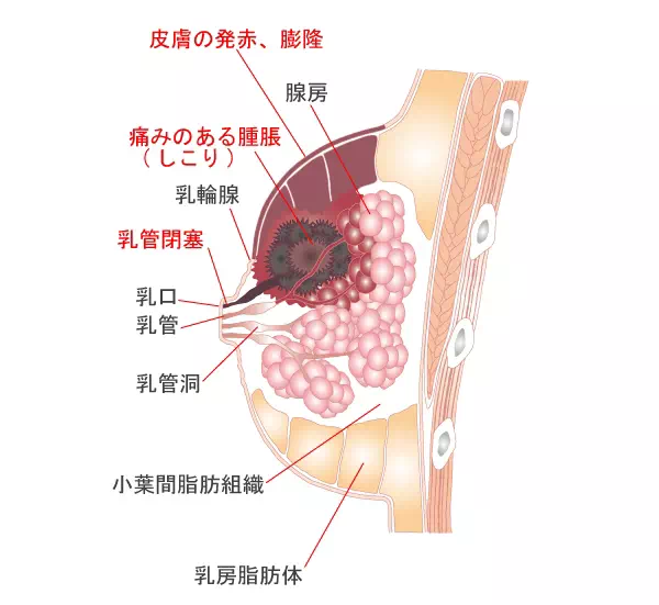 看看是不是这个原因造成的!_乳腺炎