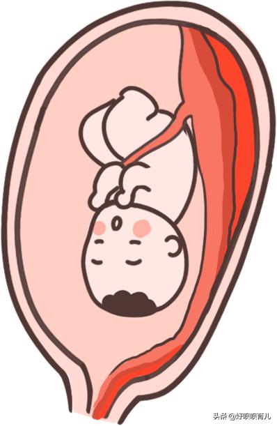 原创孕晚期羊水早破二胎妈妈以为要生了超淡定医生这是胎盘早剥