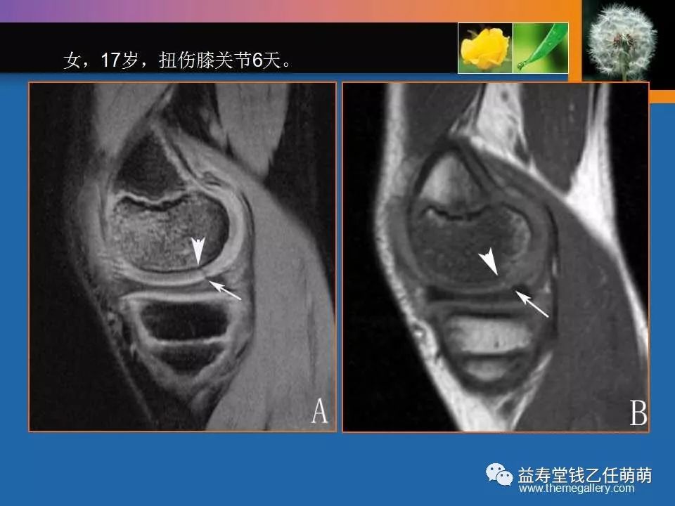 膝關節損傷mri診斷