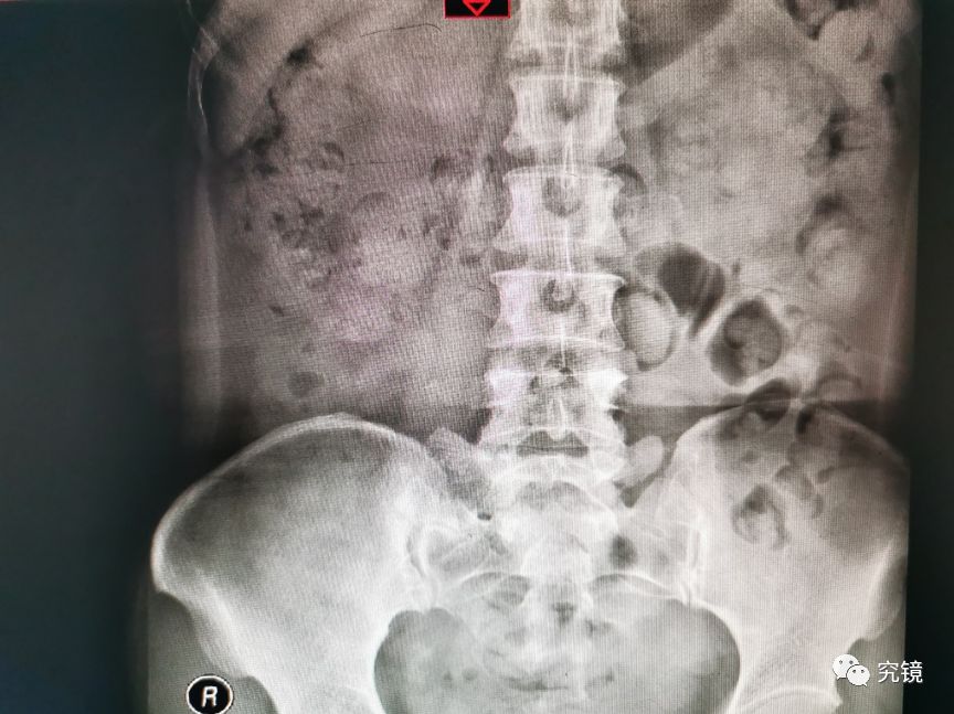 既往右侧输尿管软镜术前kub平片