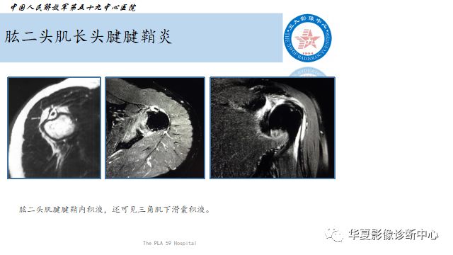 肱二头肌长头腱的点点滴滴您清楚吗