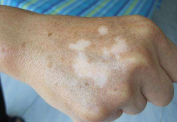 白癜风患者怀孕后怎么办?做到这4点,可帮助患者避免扩散