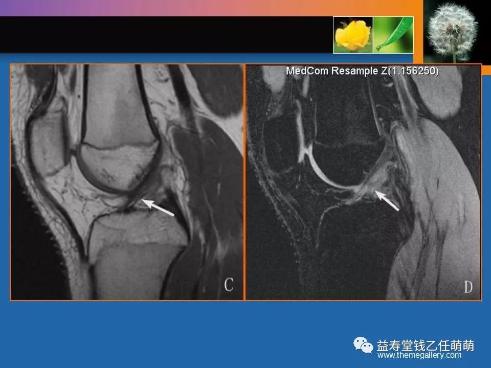 膝关节损伤mri诊断