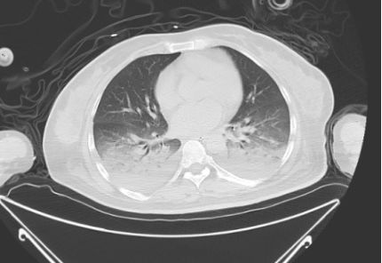 感染,脓毒性休克加重心脏损伤,导致脓毒性心肌病,同时患者存在ards