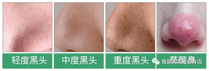 画面极度舒适十几年顽固老黑头30秒彻底连根拔起毛孔畅快呼吸原来是