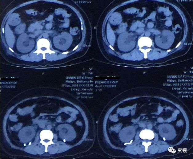 請腎內科會診,行ct檢查提示:雙側輸尿管結石,雙側輸尿管雙j管位置異常