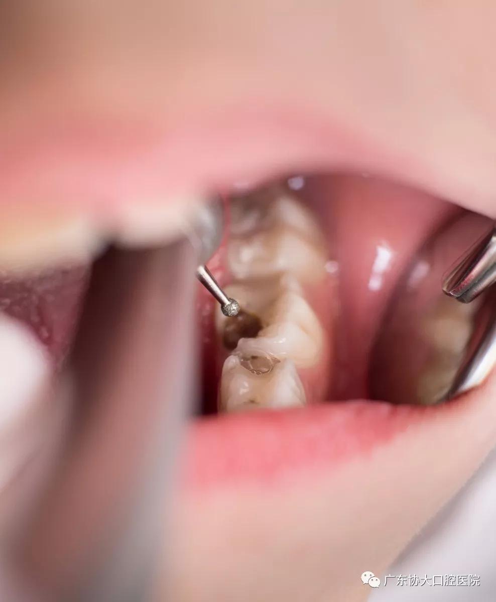 协大案例龋齿充填修复实例