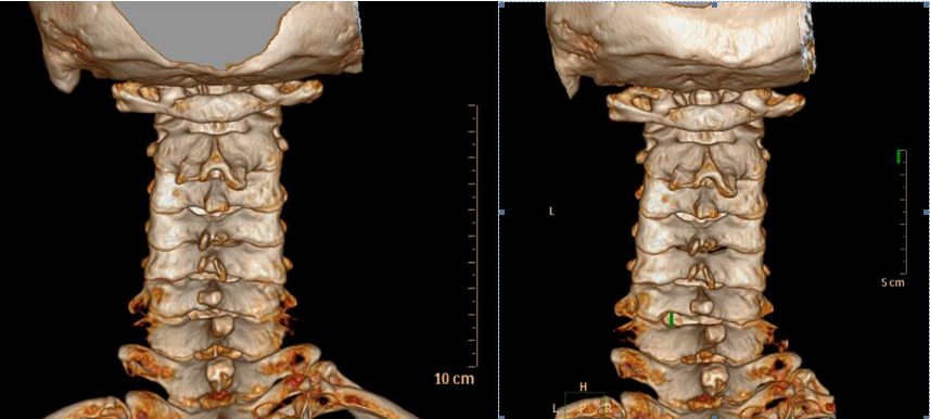 不开刀小钥匙孔里解决颈椎间盘大问题