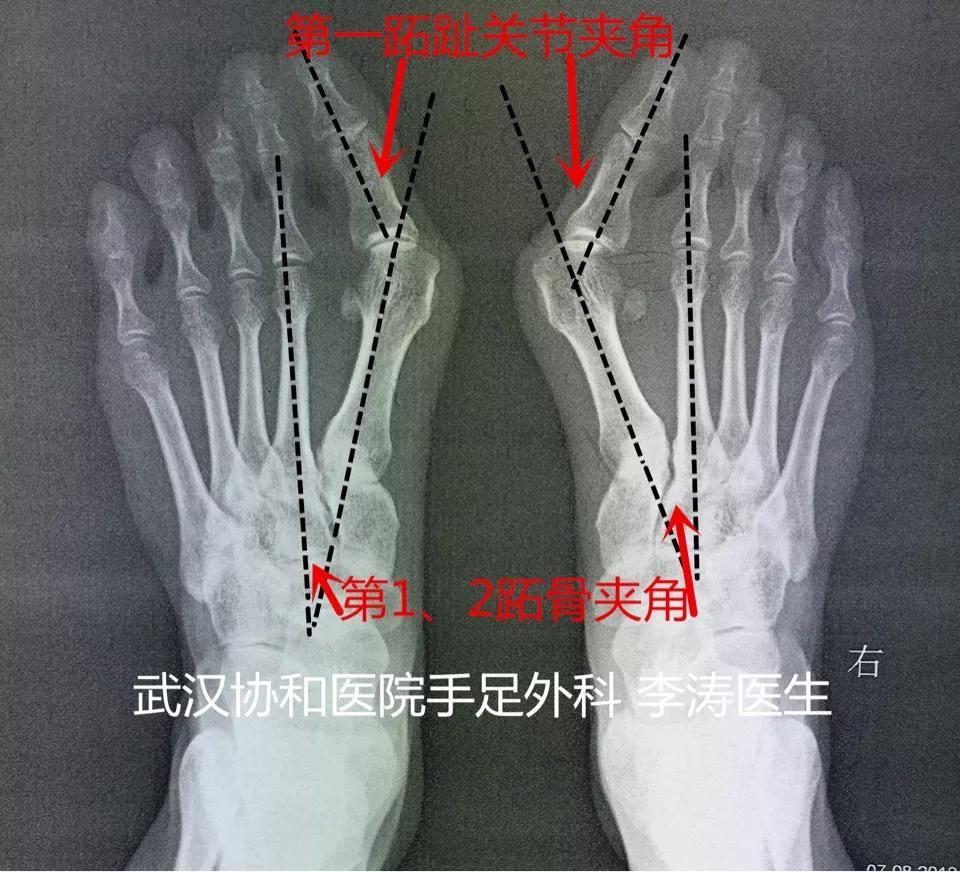 拇外翻是指拇指在第一跖趾关节向外侧偏移超过正常的生理角度的一种