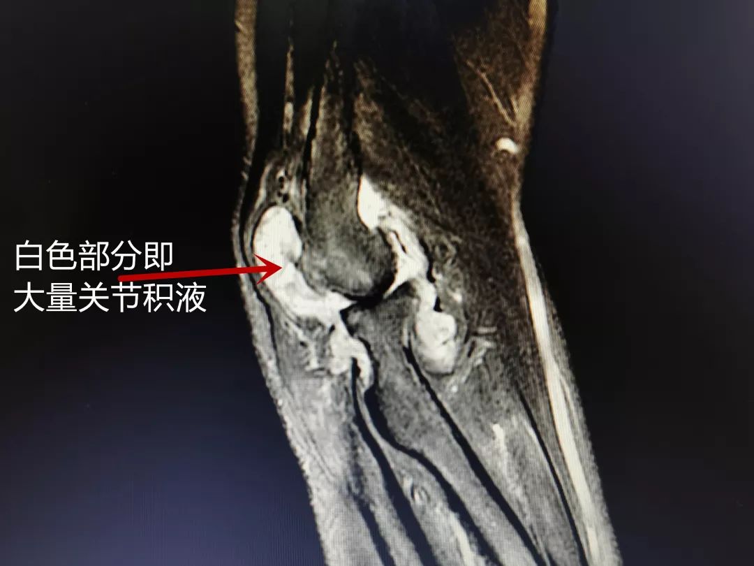 滑膜出现增生,软骨受到损伤,张大妈的肘关节腔内有大量炎性积液;"我的