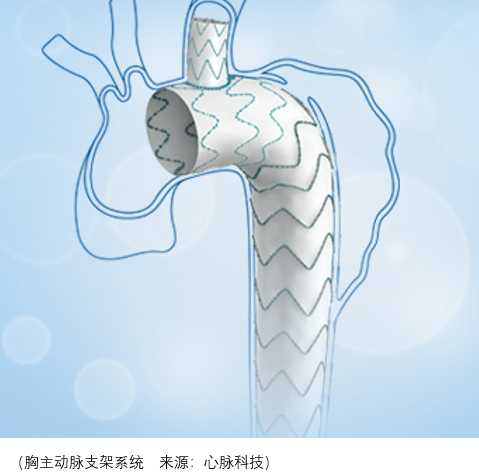 产品为外周血管支架系统,外周血管球囊扩张导管