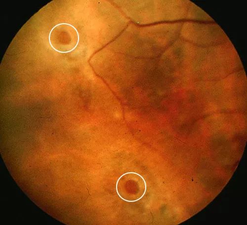 认识孔源性视网膜脱离的罪魁祸首