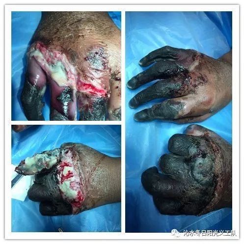 的诊断,确诊为电击伤,双手指头均干枯缺血坏死,如果不及时进行截肢