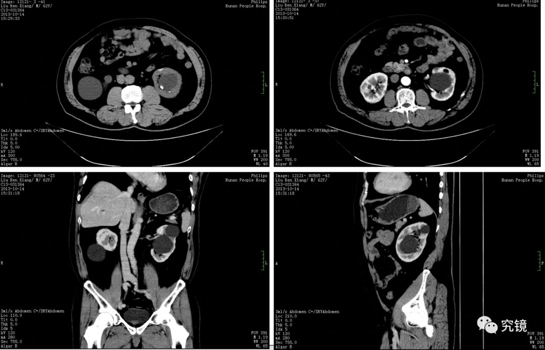 2013年10月及2019年2月ct,kub提示:雙腎多發囊腫,左腎結石,左側輸尿管