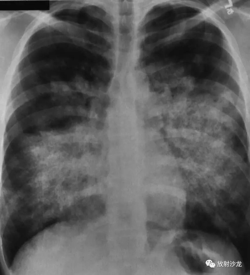 肺泡蛋白沉积症:胸部正位片示双肺多发细小结节影,融合成淡薄片状,沿