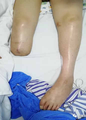 91号作品:输尿管上段结石致脓毒症休克,出血性休克并肢体坏疽一例