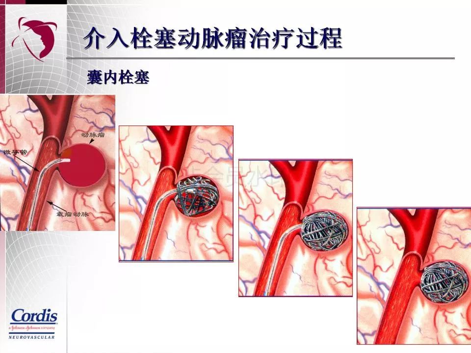 神經介入-為拯救更多生命