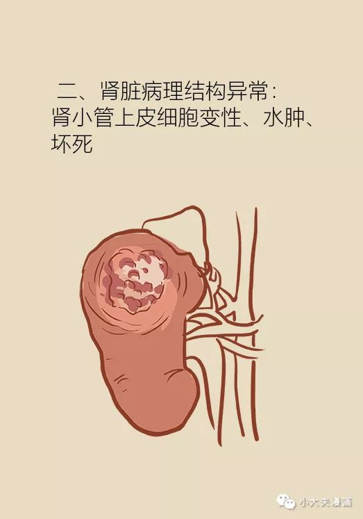 四类药物容易引起肾损伤你谨慎用药了吗