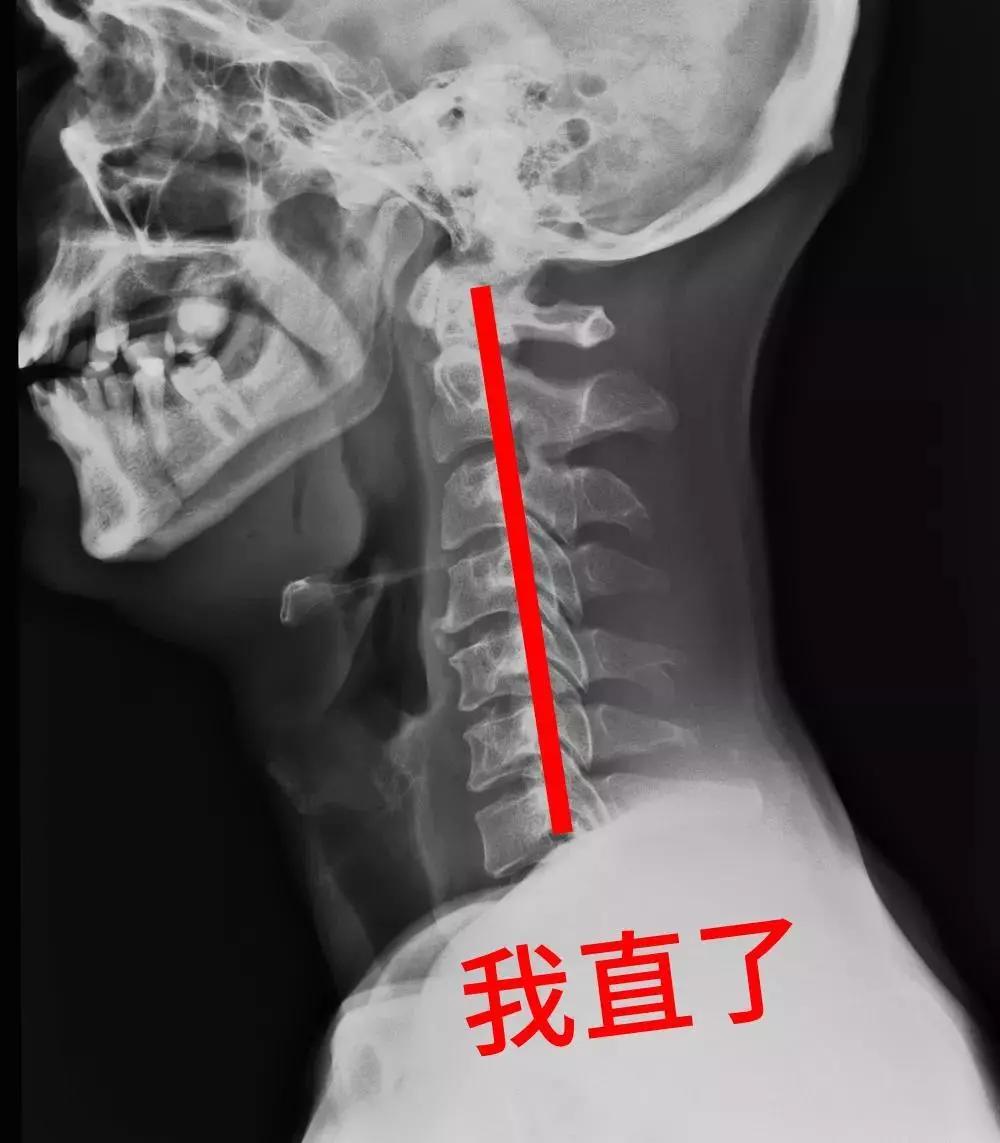 脖子骨头弯曲图片图片