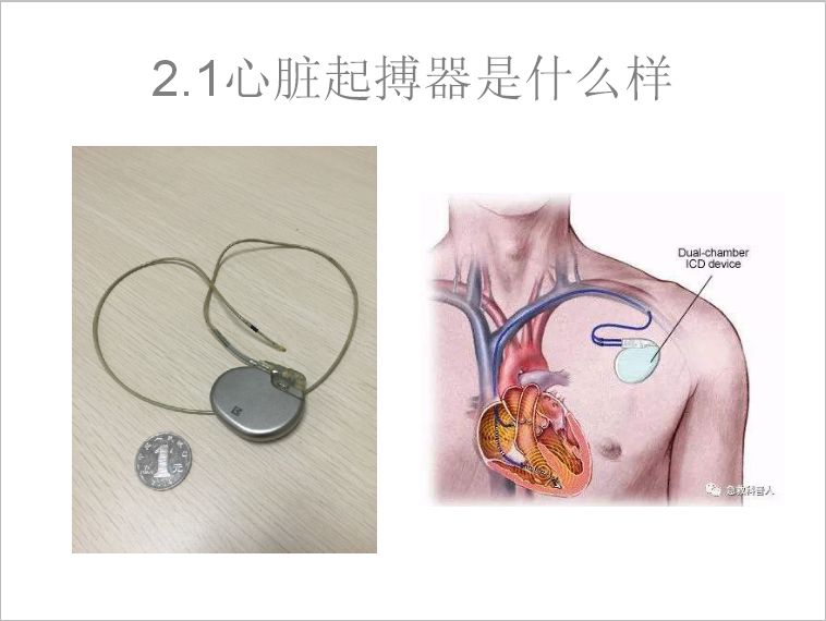 体内起搏器图片