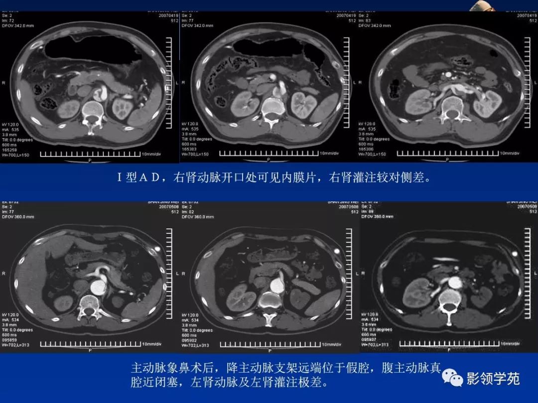 主动脉夹层壁间血肿及穿通性溃疡影像诊断与鉴别