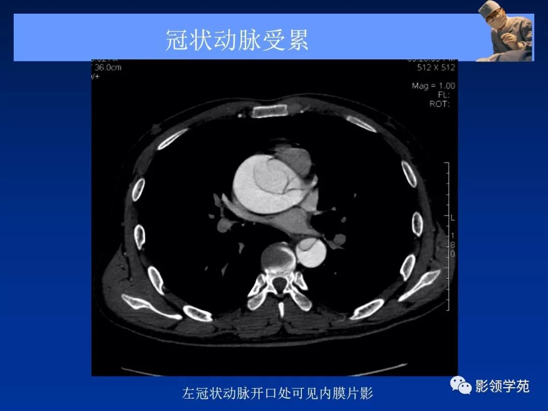 主动脉夹层壁间血肿及穿通性溃疡影像诊断与鉴别