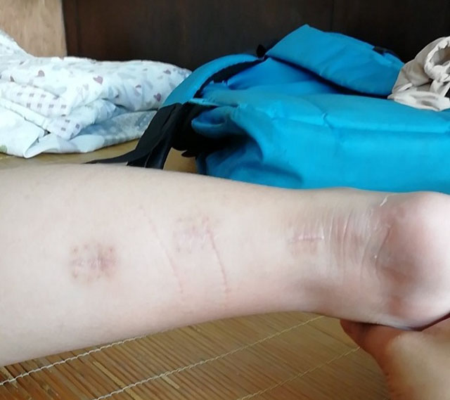 为啥踮着脚尖走路跟腱挛缩骨科专家协助神经肌肉科行跟腱挛缩手术