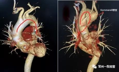 右位主动脉弓是一种少见的先天性血管变异,发病率约万分之四,其本身不