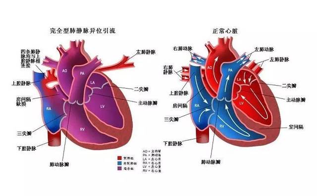 完全型肺静脉异位引流心脏与正常心脏大部分患者早期就手术拖到成年