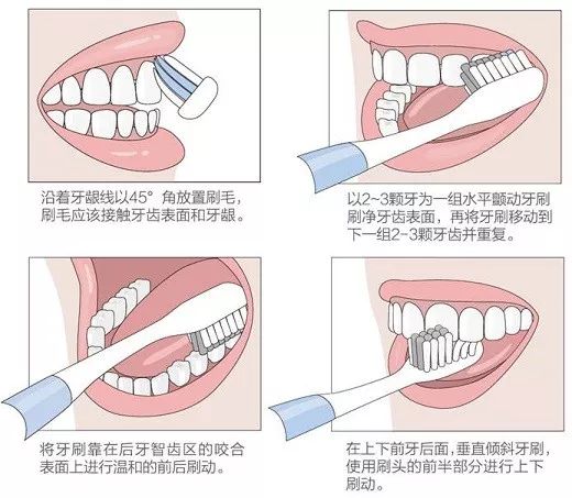 每天刷牙为何还会蛀牙崇明口腔专家来解答