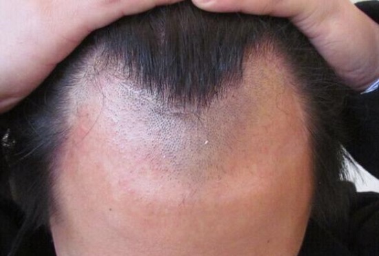 在植发医院植发一个月后,开始掉头发,怎么办?