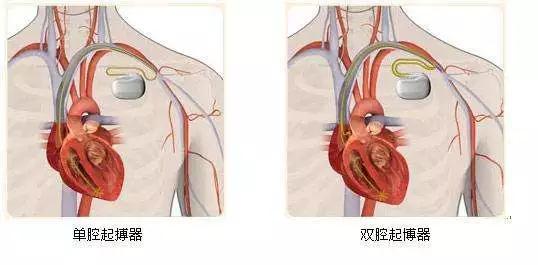 論心臟起搏器的起源,風險及注意事項