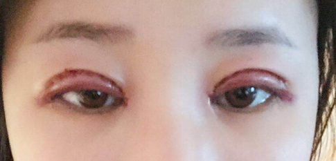 为什么双眼皮术后都要经历肿胀期