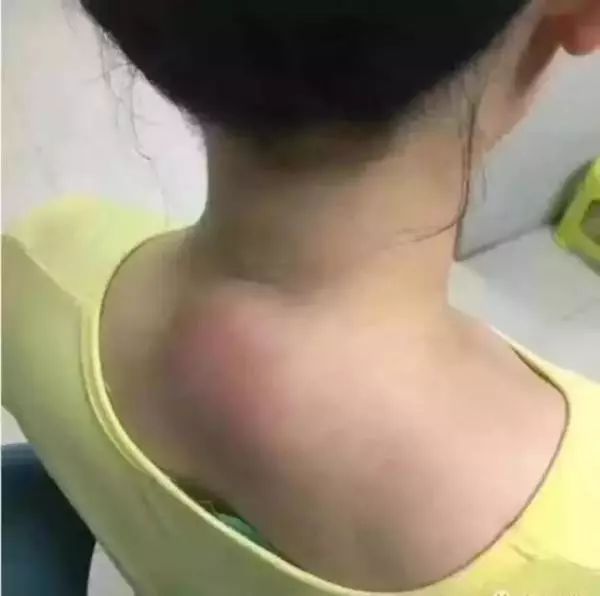 这是脑梗的前兆!_刮痧