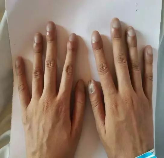 嘴唇是蓝的26岁女孩被误诊多年拖了25年的疾病背后有个心酸故事