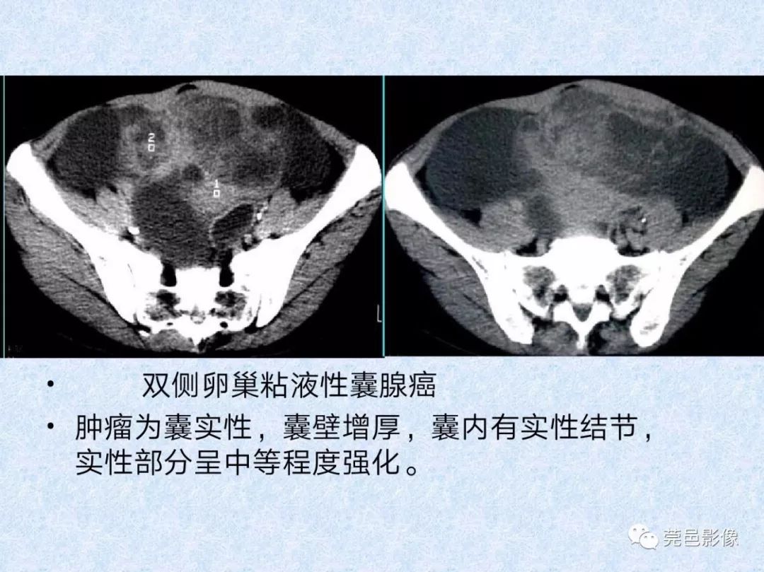 卵巢纤维瘤ct影像表现