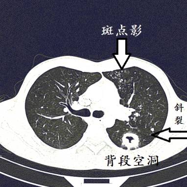 肺结核肺癌ct图片图解图片