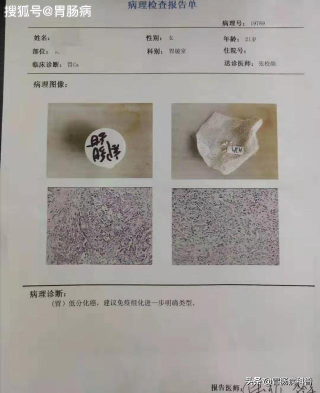 痛心胃疼1年数次拒绝胃镜21岁大二女生进展期胃癌