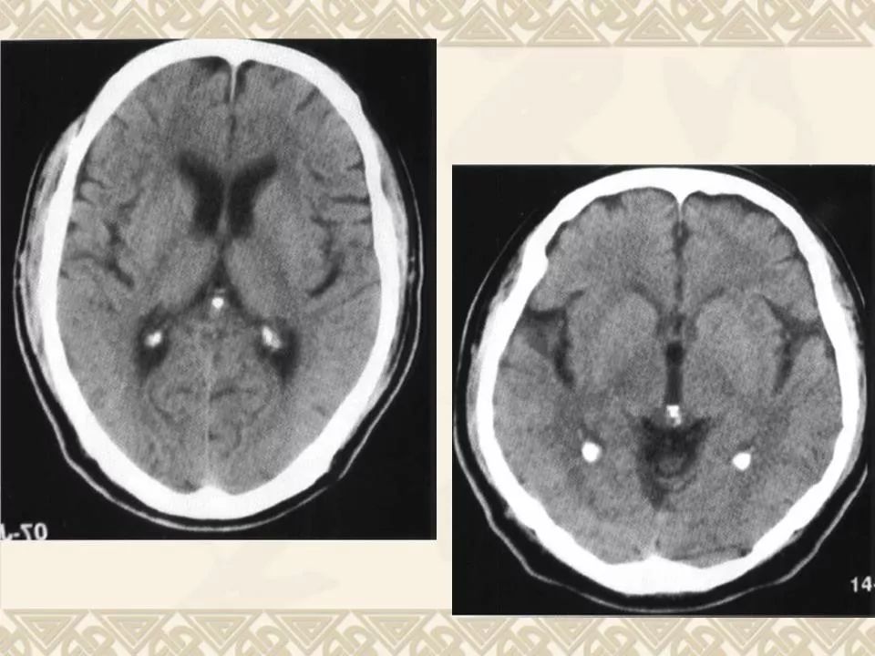 侧脑室脉络丛钙化图片