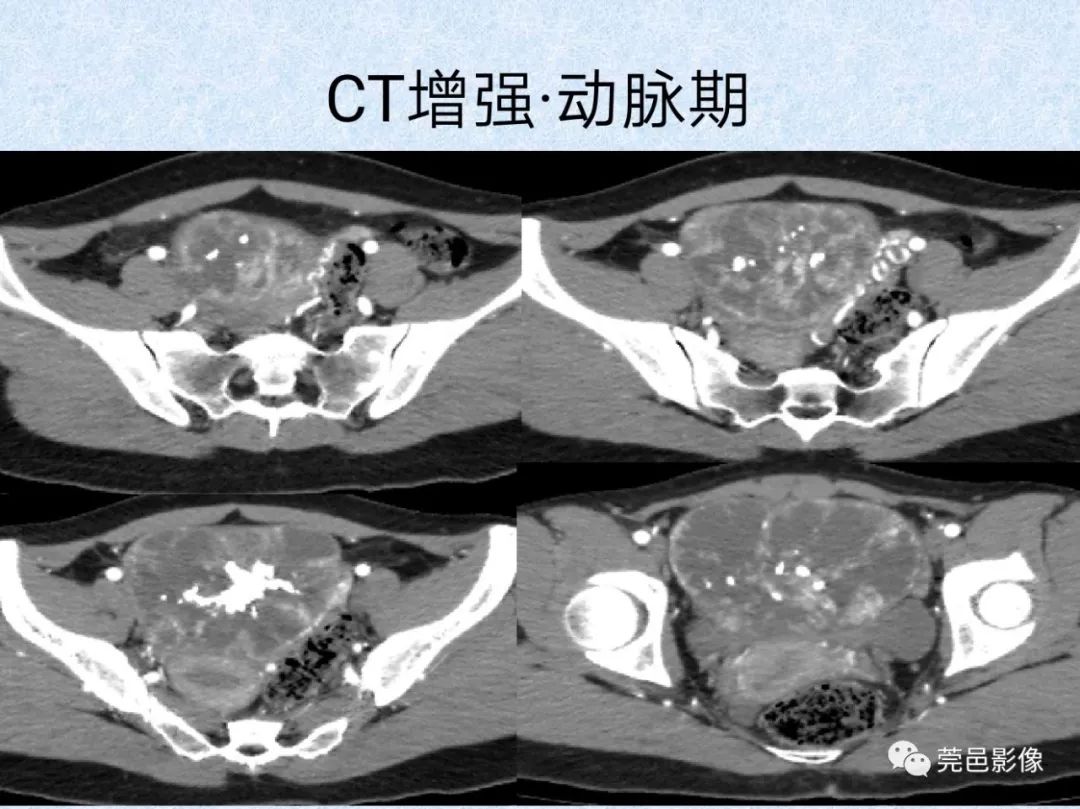 卵巢纤维瘤ct影像表现